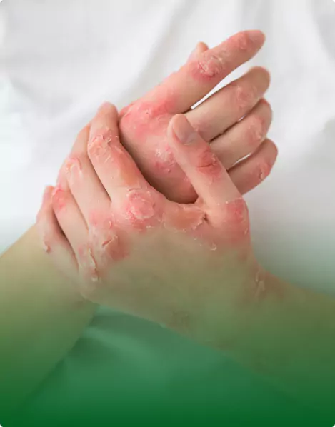Psoriasis and Skin Care